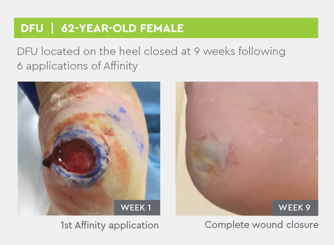 DFU located on the heel closed at 9 weeks following 6 applications of Affinity