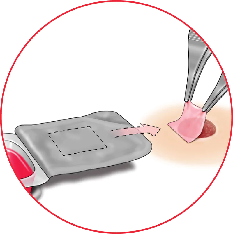 Place Affinity onto the wound with the stromal side in contact with the wound bed